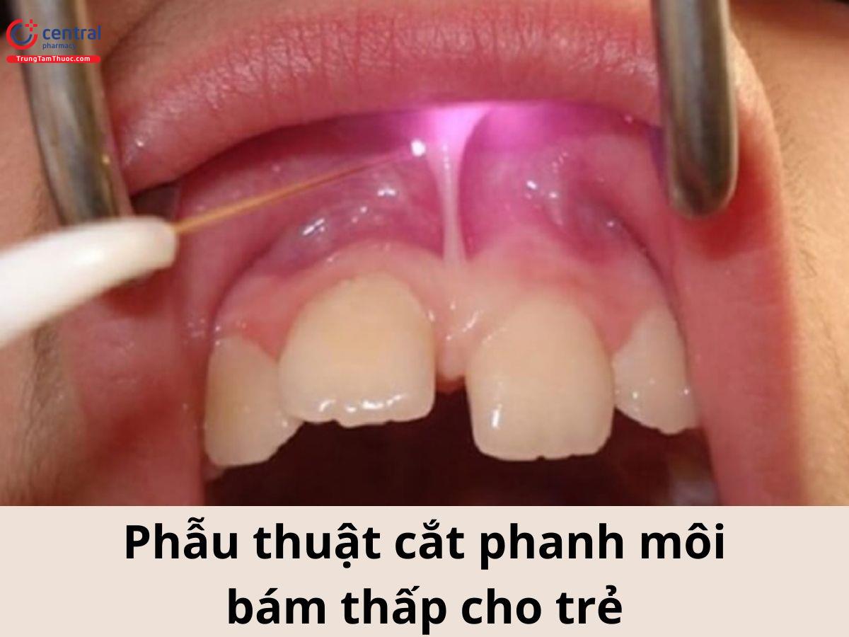 Phẫu thuật cách phanh môi cho trẻ là cách điều trị phổ biến