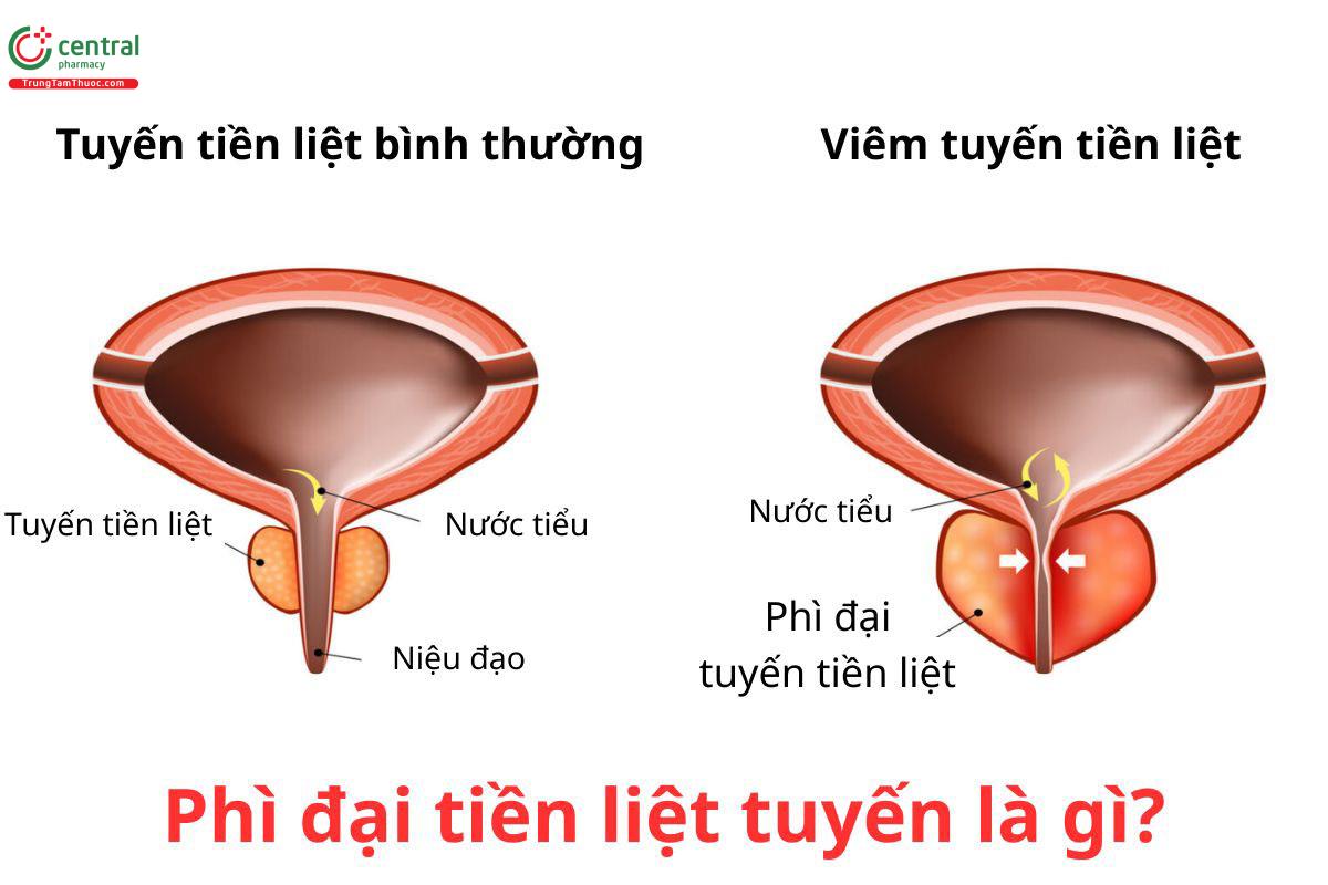 Tăng sản xuất tuyến tiền liệt là gì?
