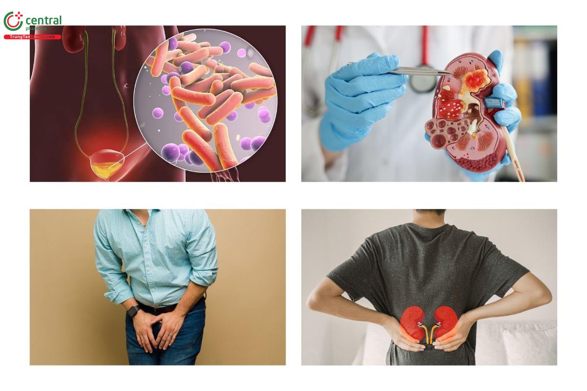 U xơ tiền liệt tuyến có nguy hiểm không? Biến chứng của u xơ tiền liệt tuyến