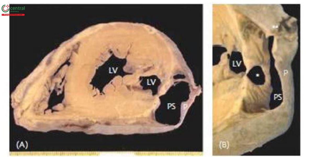 Hình 4. Phình giả thất trái. PS: phình giả; LV: thất trái; P: màng ngoài tim.