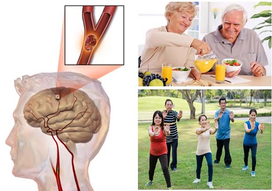 Cách phòng ngừa tai biến mạch máu não
