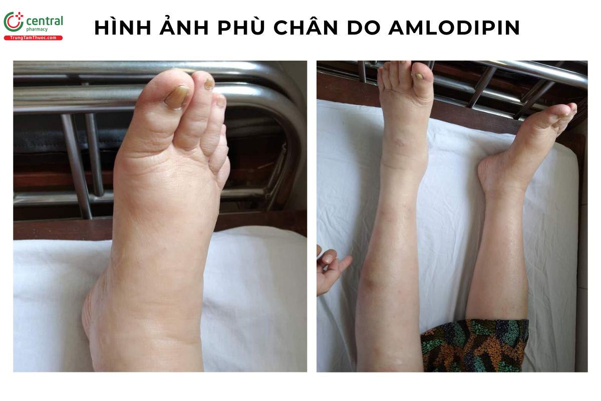 Hình ảnh: một bệnh nhân phù khá đáng kể do Amlodipin.