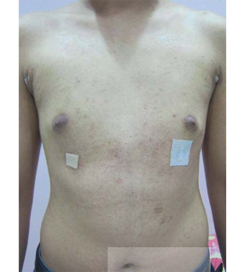 Gynaecomastia vú to ở nam