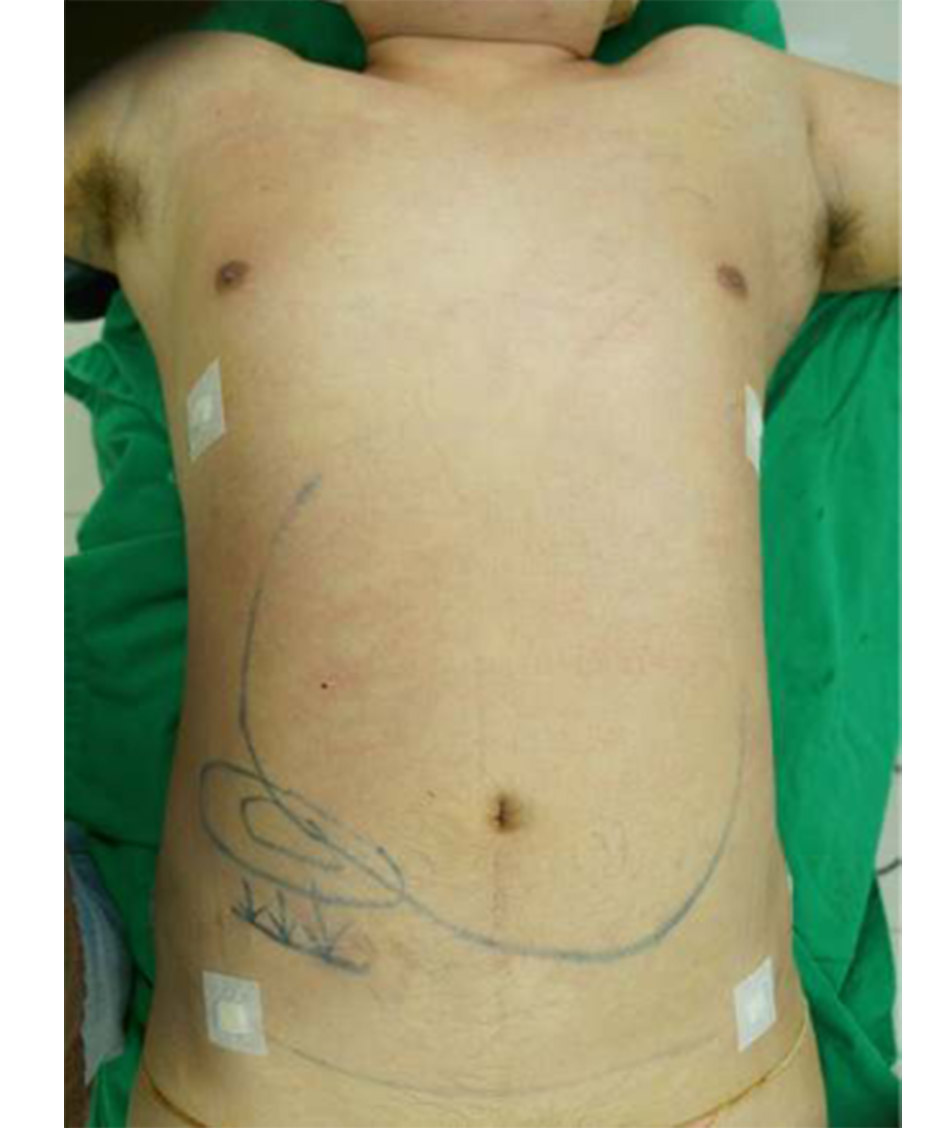 Gynaecomastia vú to ở nam