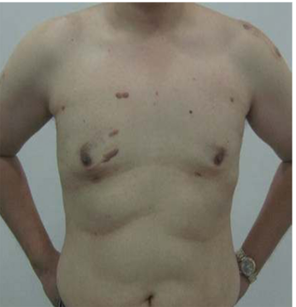 Gynaecomastia vú to ở nam