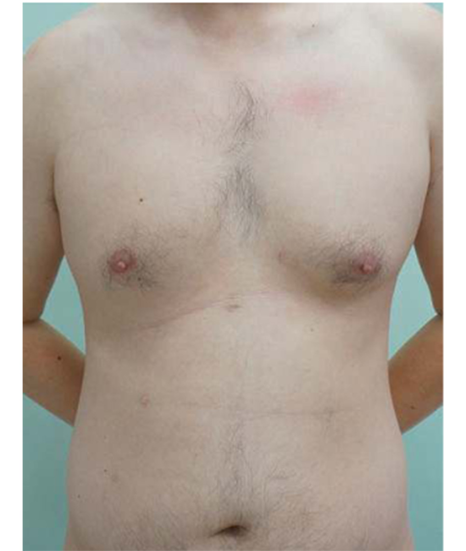 Gynaecomastia vú to ở nam