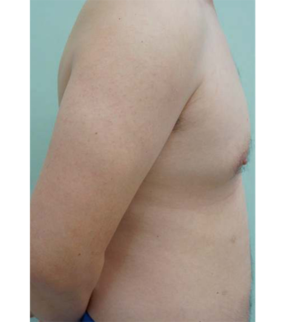 Gynaecomastia vú to ở nam