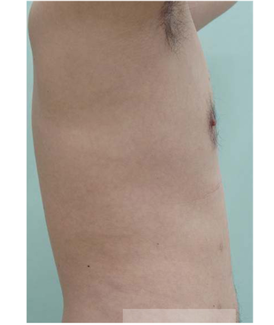 Gynaecomastia vú to ở nam