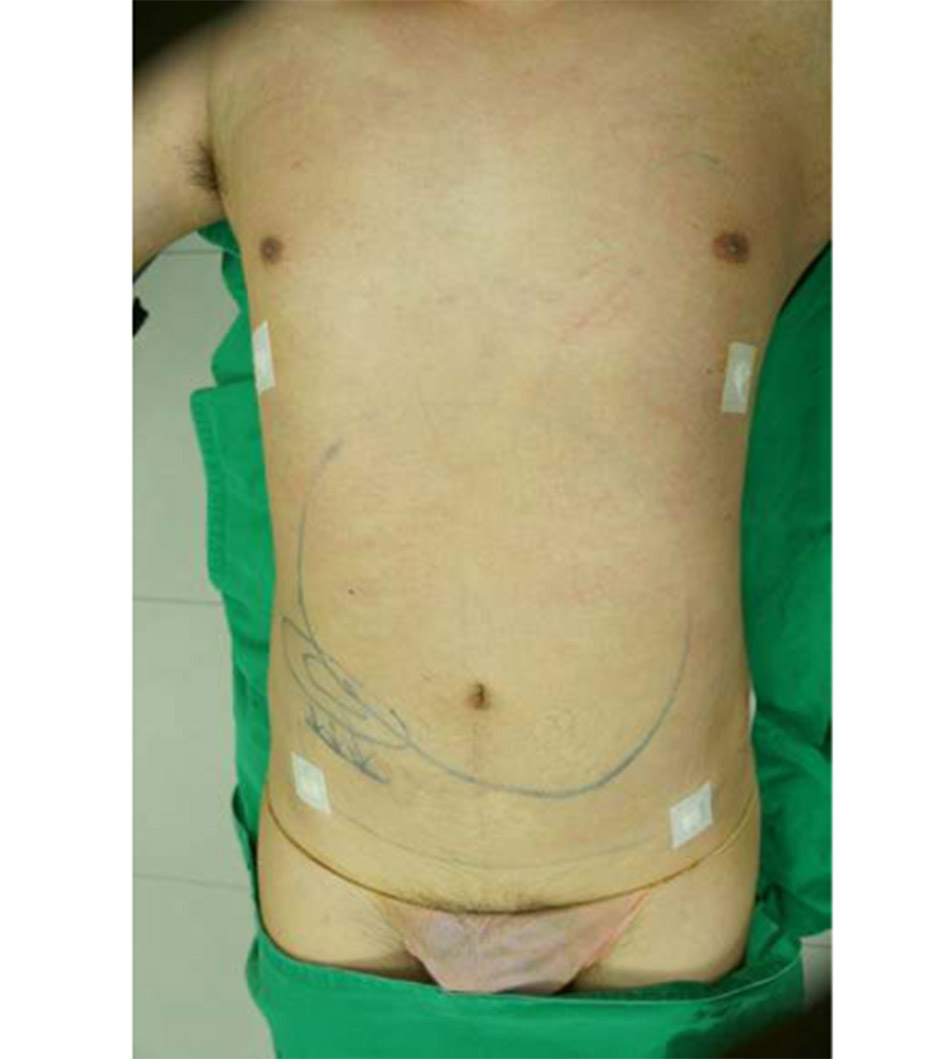 Gynaecomastia vú to ở nam