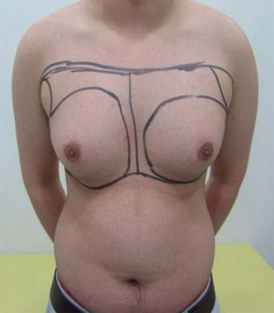 Gynaecomastia vú to ở nam
