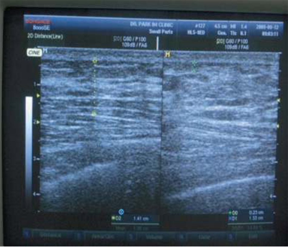 Gynaecomastia vú to ở nam