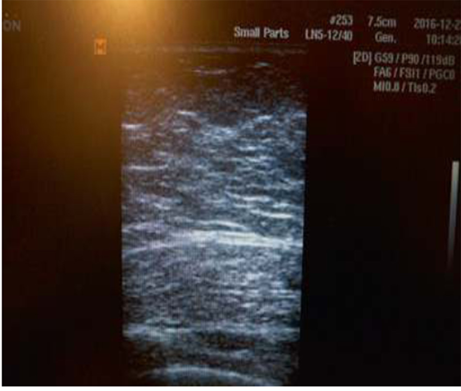 Gynaecomastia vú to ở nam