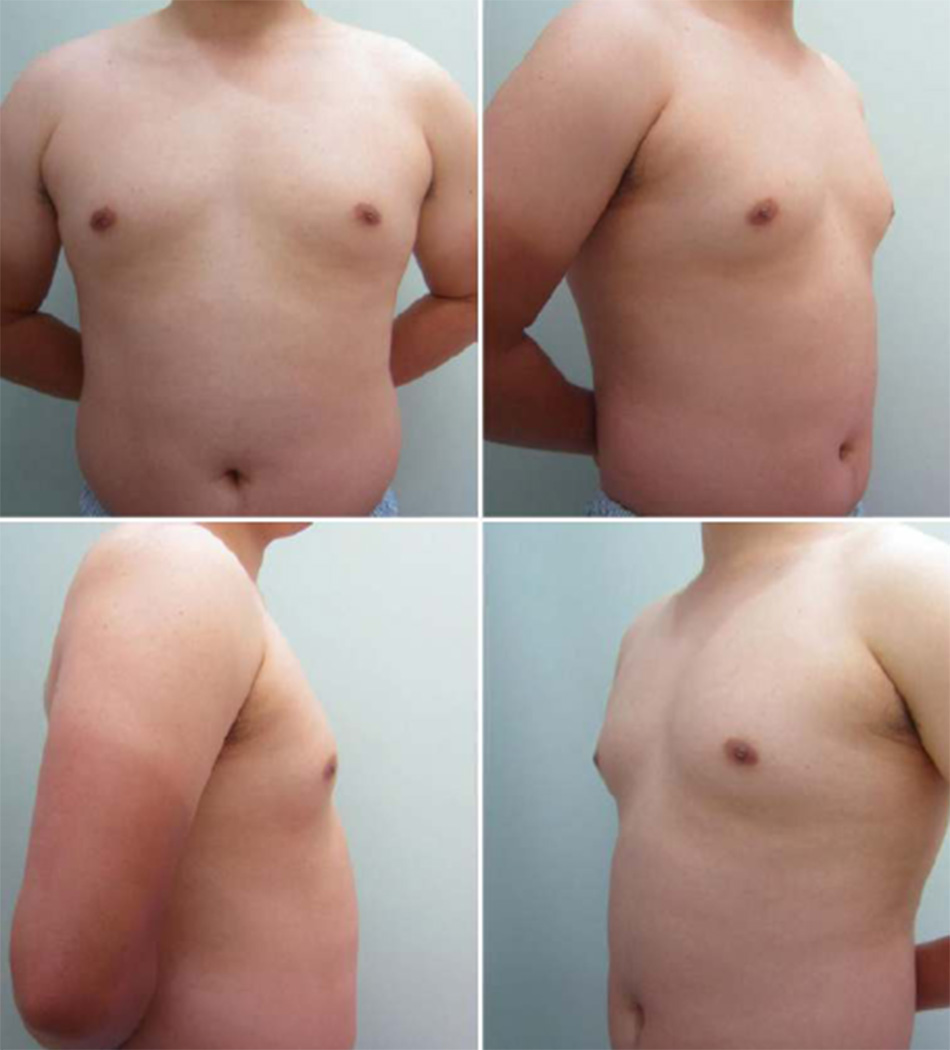 Gynaecomastia vú to ở nam