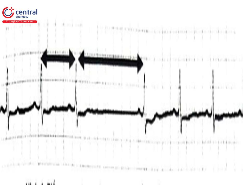 Hình 1. Blốc xoang nhĩ, khoảng ngừng dài bằng 2 lần khoảng P-P cơ bản. Nguồn: Wagner GS, 2014