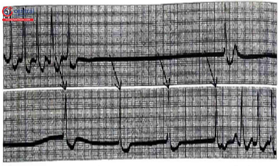 Hình 3. Bệnh nhân với tiền sử ngất, ECG ghi nhận ngưng xoang dài với thoát bộ nối (dấu mũi tên). Nguồn: Wagner GS, 2014