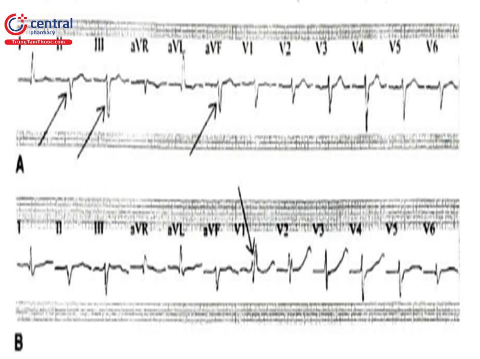 Hình 13. Blốc nhánh phải và Blốc phân nhánh trái sau (sóng S ở DI, aVL).  Nguồn: Wagner GS, 2014