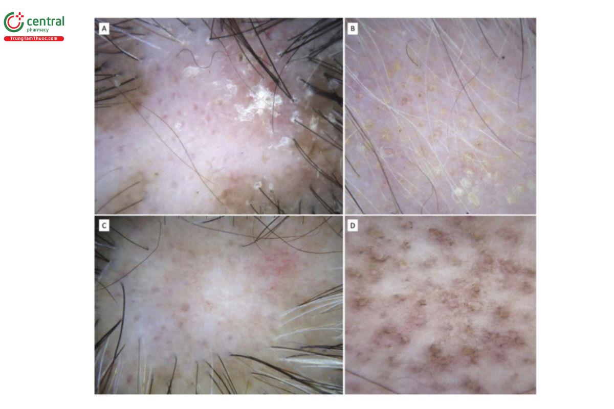 HÌNH 6.9 DLE thường cho thấy (A) vảy quanh và giữa các nang tóc và sự thay đổi màu sắc. Lưu ý các chấm đỏ nang tóc ở trung tâm tổn thương. (B) Nang tóc đặc trưng. (C) DLE ở bệnh nhân da sẫm màu: chú ý mạng lưới sắc tố bị phá hủy ở trung tâm tổn thương, được bảo tồn ở ngoại vi. Ngoài ra còn có sự hiện diện của các chấm đỏ và các mạch máu phân nhánh. (D) Mất kiểm soát sắc tố lan tỏa trong DLE được nhận thấy như những chấm dạng đốm màu xanh- xám dưới trichoscopy.