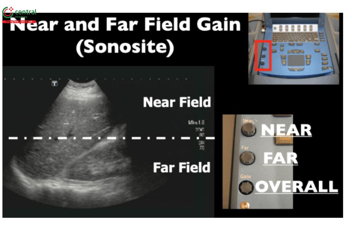 "Gain" vùng xa/gần (Sonosite).