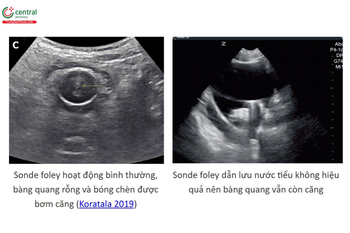 Vị trí sonde Foley