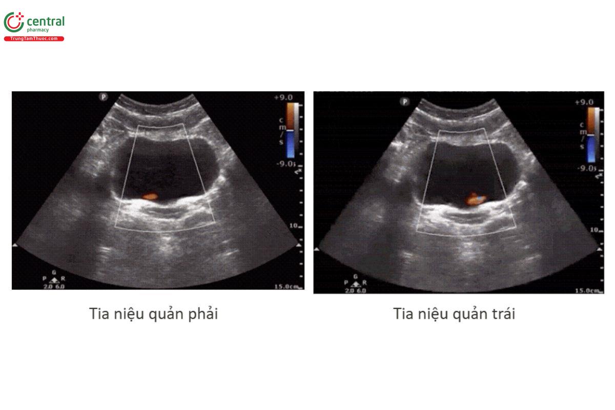 Tia niệu quản