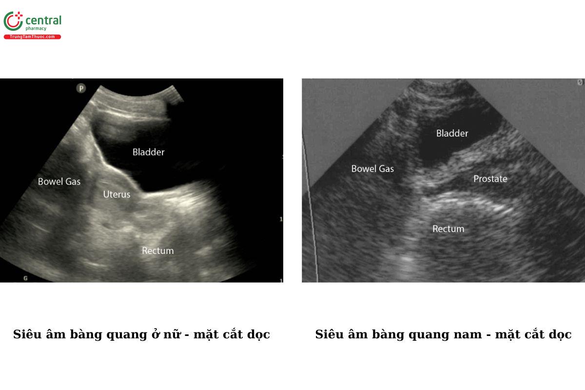 Siêu âm bàng quang - mặt cắt dọc