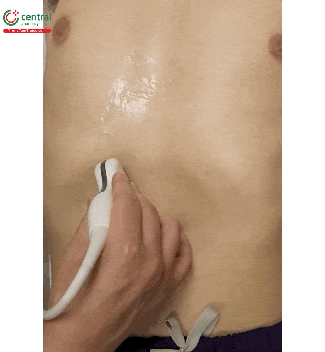 Trượt sang bên để xem tĩnh mạch cửa theo mặt cắt ngang