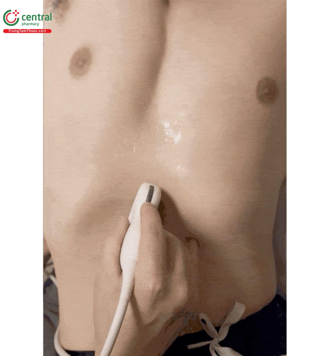 Xoay theo chiều kim đồng hồ để tìm MLF