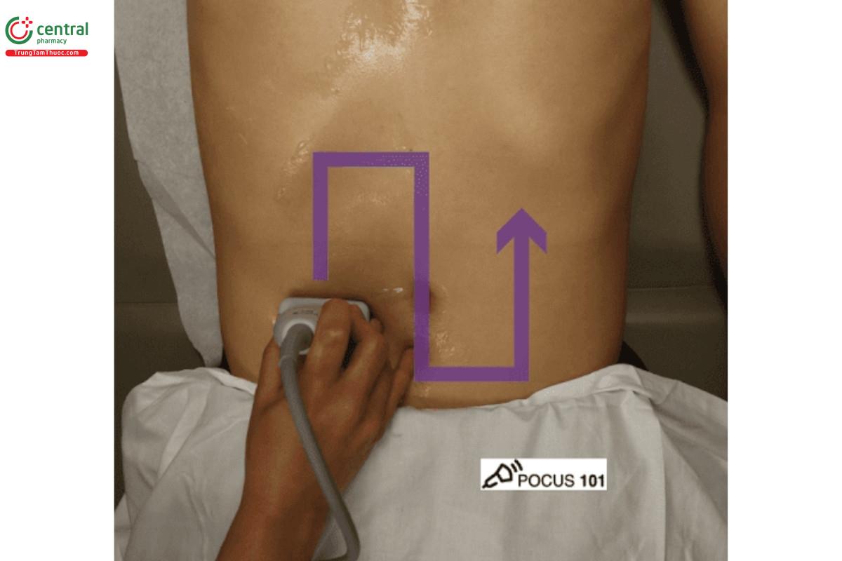Kỹ thuật cắt cỏ trong siêu âm SBO
