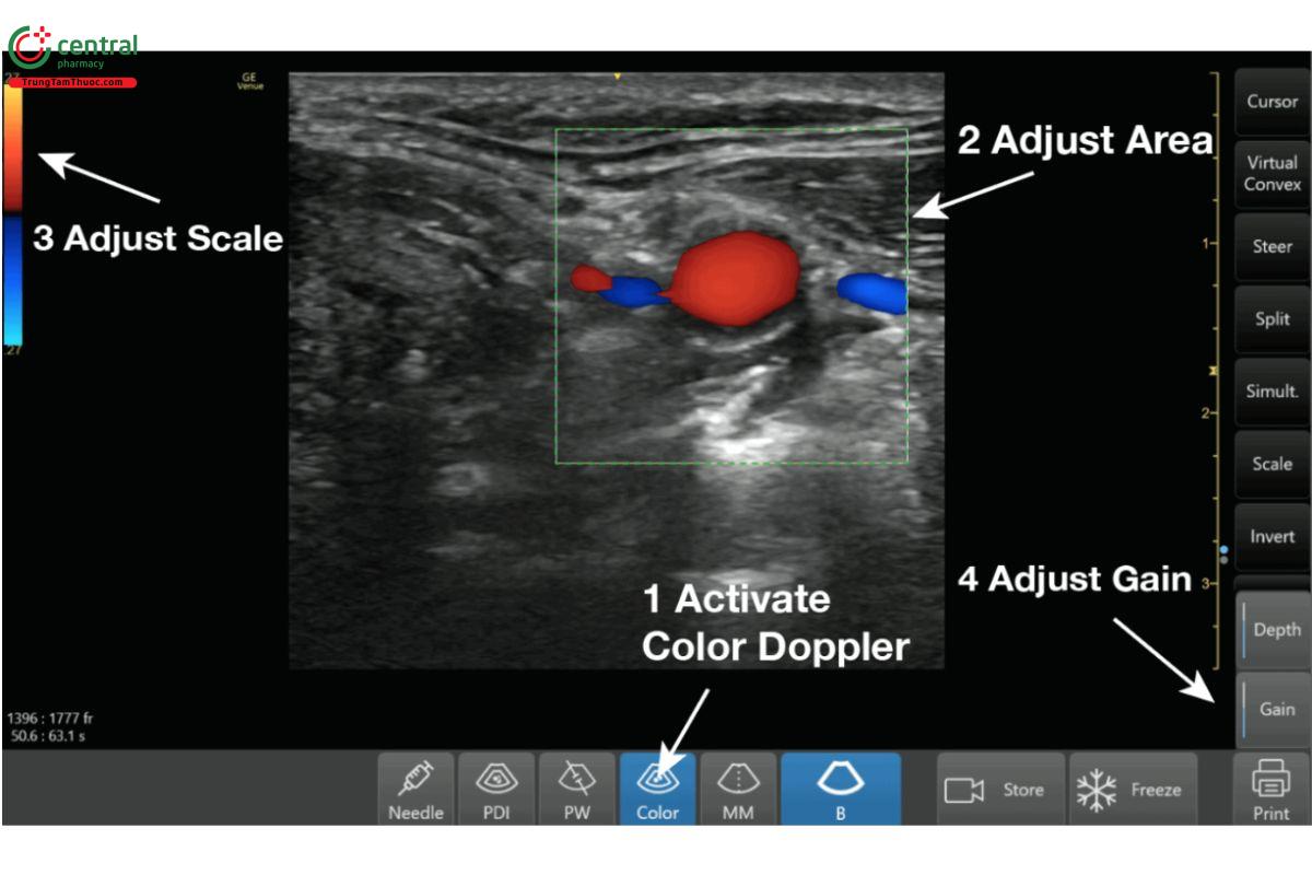 Các bước thực hiện siêu âm Doppler màu.