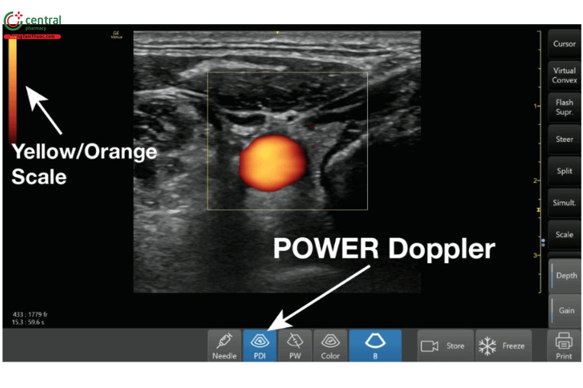 Doppler năng lượng (Power Doppler Mode).