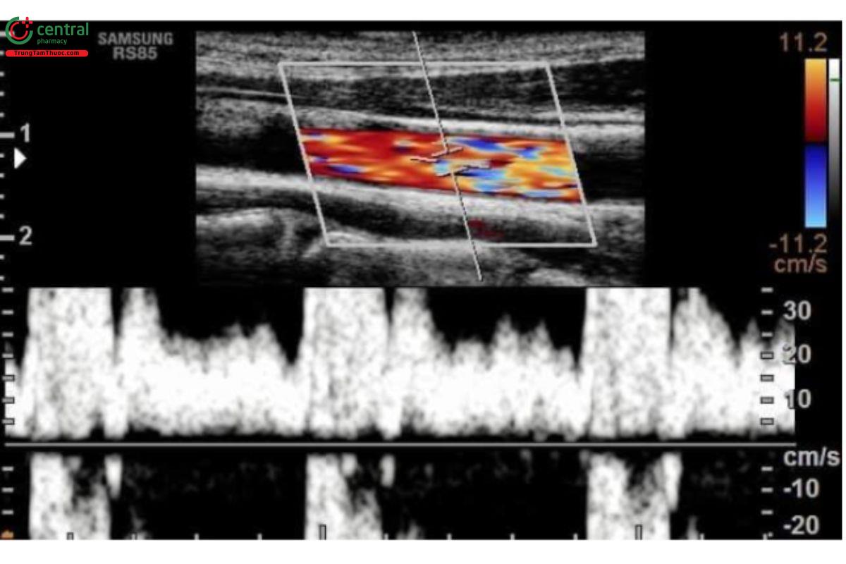 Tín hiệu nhiễu trên Doppler xung