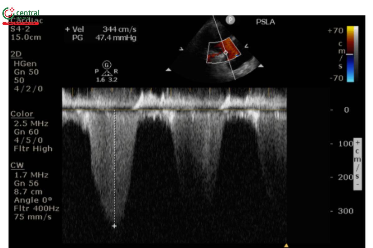 Hở van 3 lá (Tricuspid Regurgitation) - Doppler liên tục (CW).
