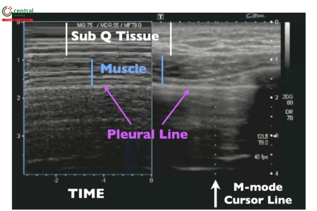 Sub Q Tissue: mô dưới da; Muscle: cơ; Pleural line: đường màng phổi.