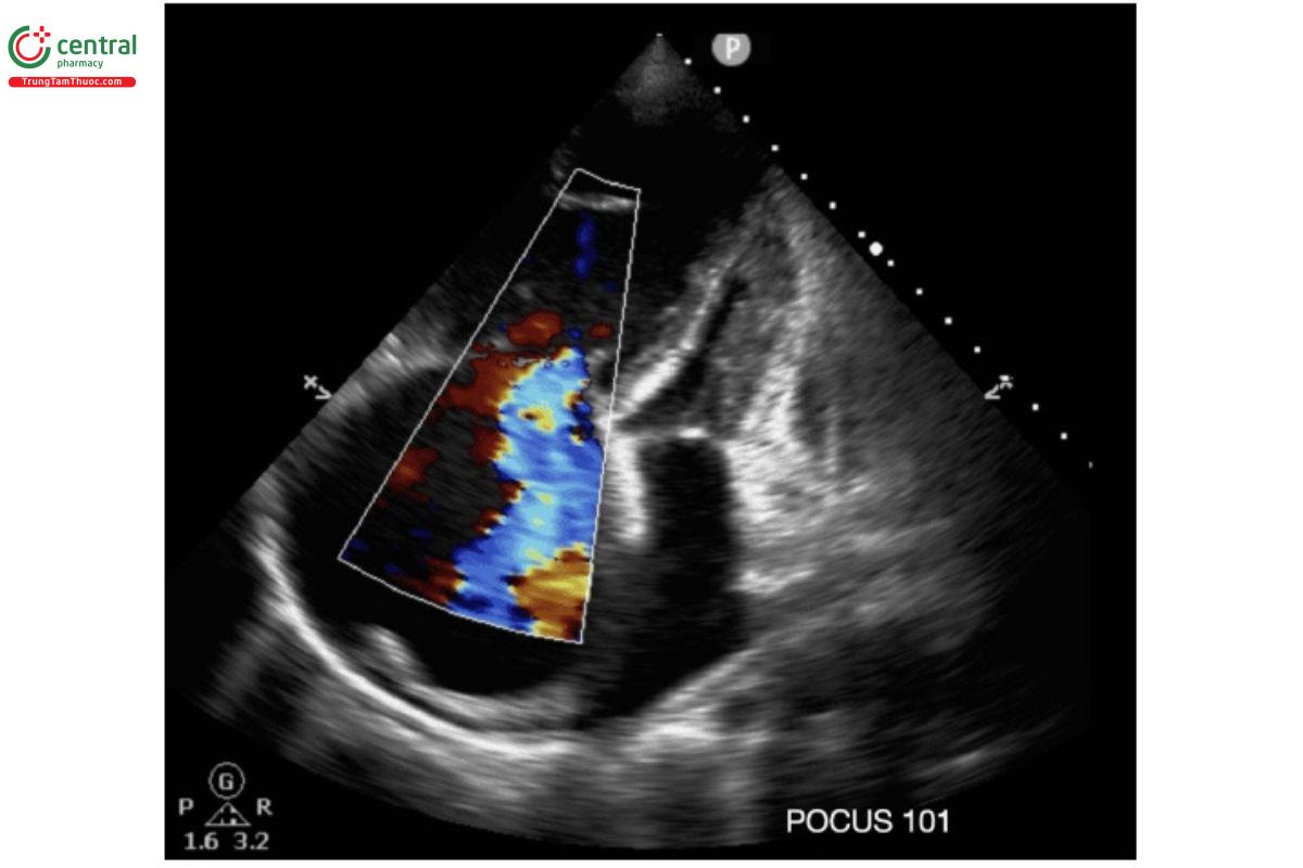 Sử dụng Doppler màu