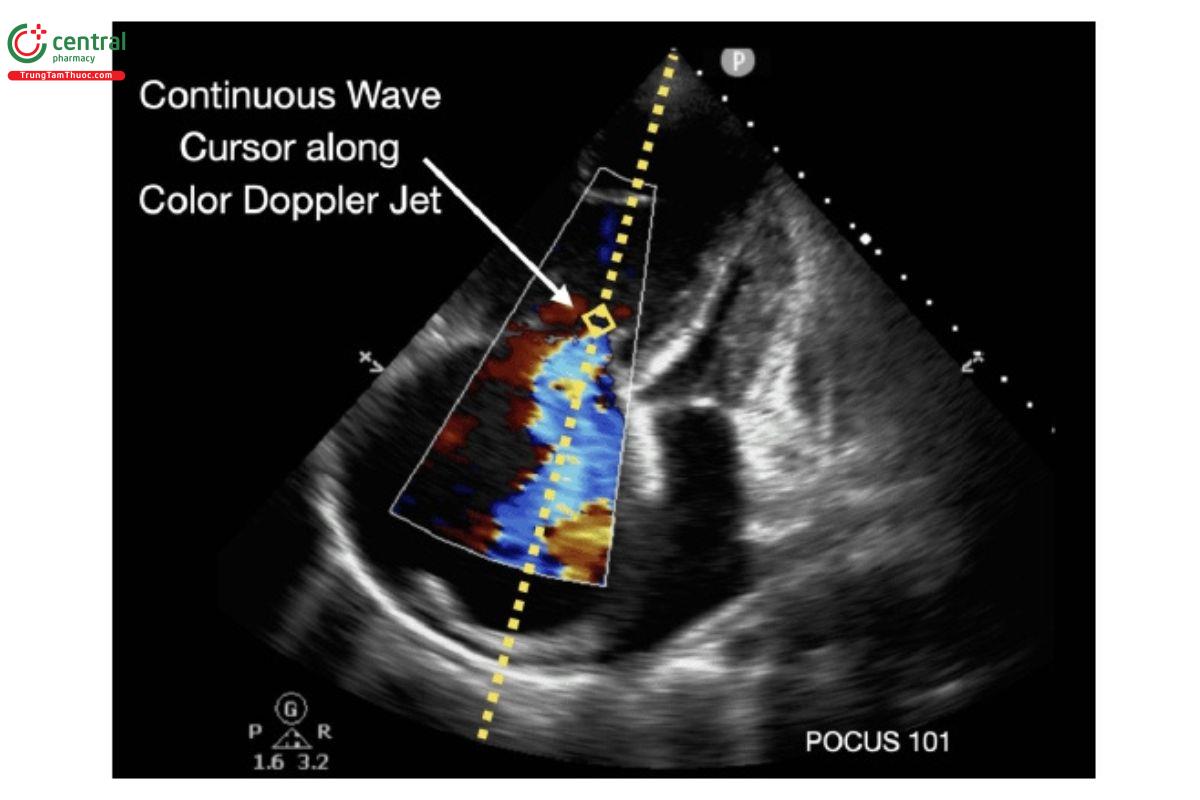 Sử dụng Doppler màu