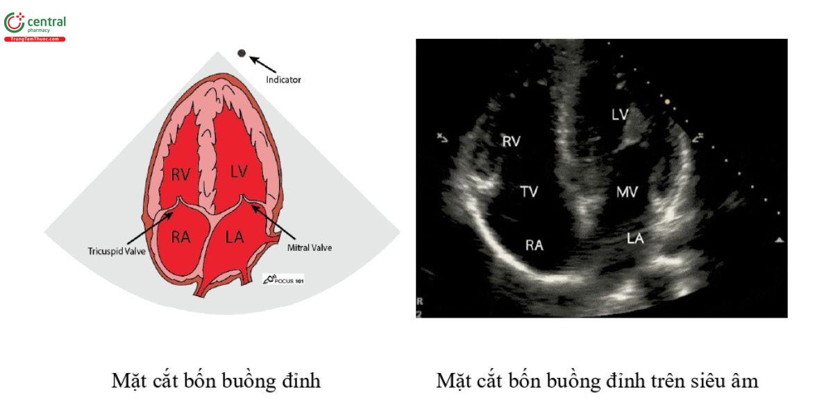 Mặt cắt 4 buồng đỉnh (A4C) 