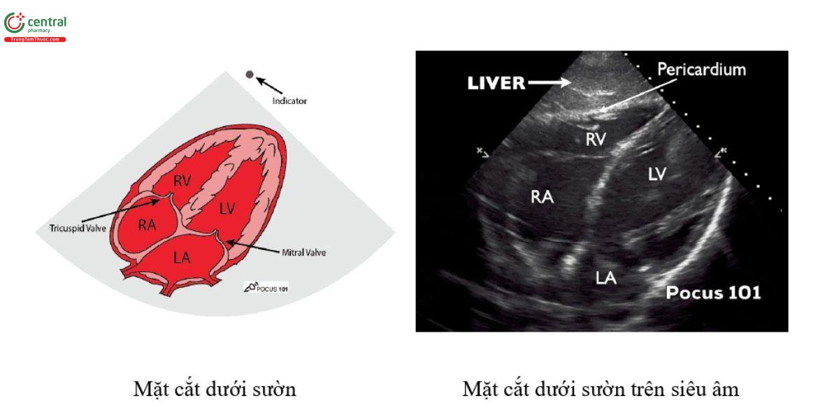 Mặt cắt dưới mũi ức (dưới sườn)