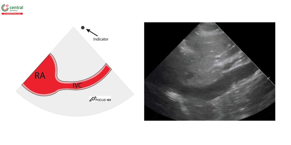 Mặt cắt tĩnh mạch chủ dưới (IVC) 