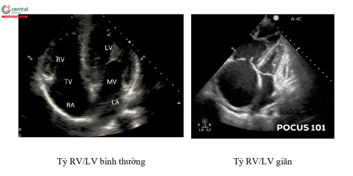 tỷ RV/LV tăng