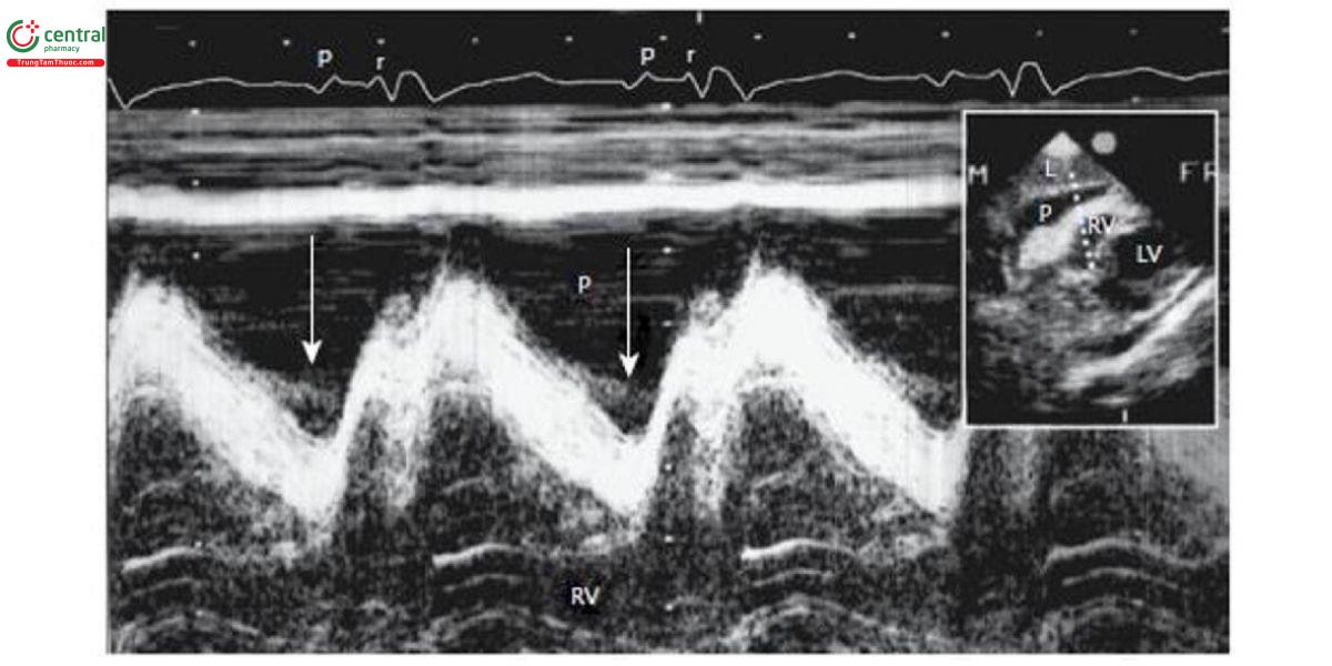Hình 3. Siêu âm tim mặt cắt 4 buồng dưới sườn cho thấy thành thất phải bị chèn ép ở bệnh nhân thủng tim bán cấp. Thành thất phải di chuyển vào trong thời kỳ tâm trương.
