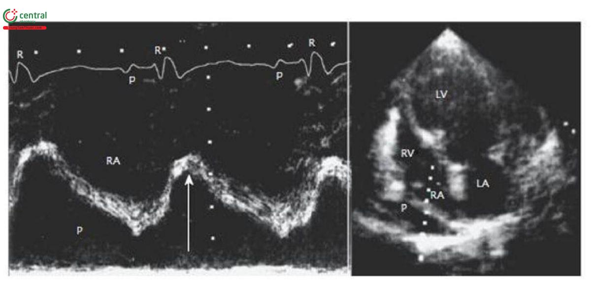 Hình 2. Siêu âm tim mặt cắt 4 buồng từ mỏm ở bệnh nhân thủng tim bán cấp, thành sau nhĩ phải di chuyển vào trong giai đoạn sớm thời kỳ tâm thu.
