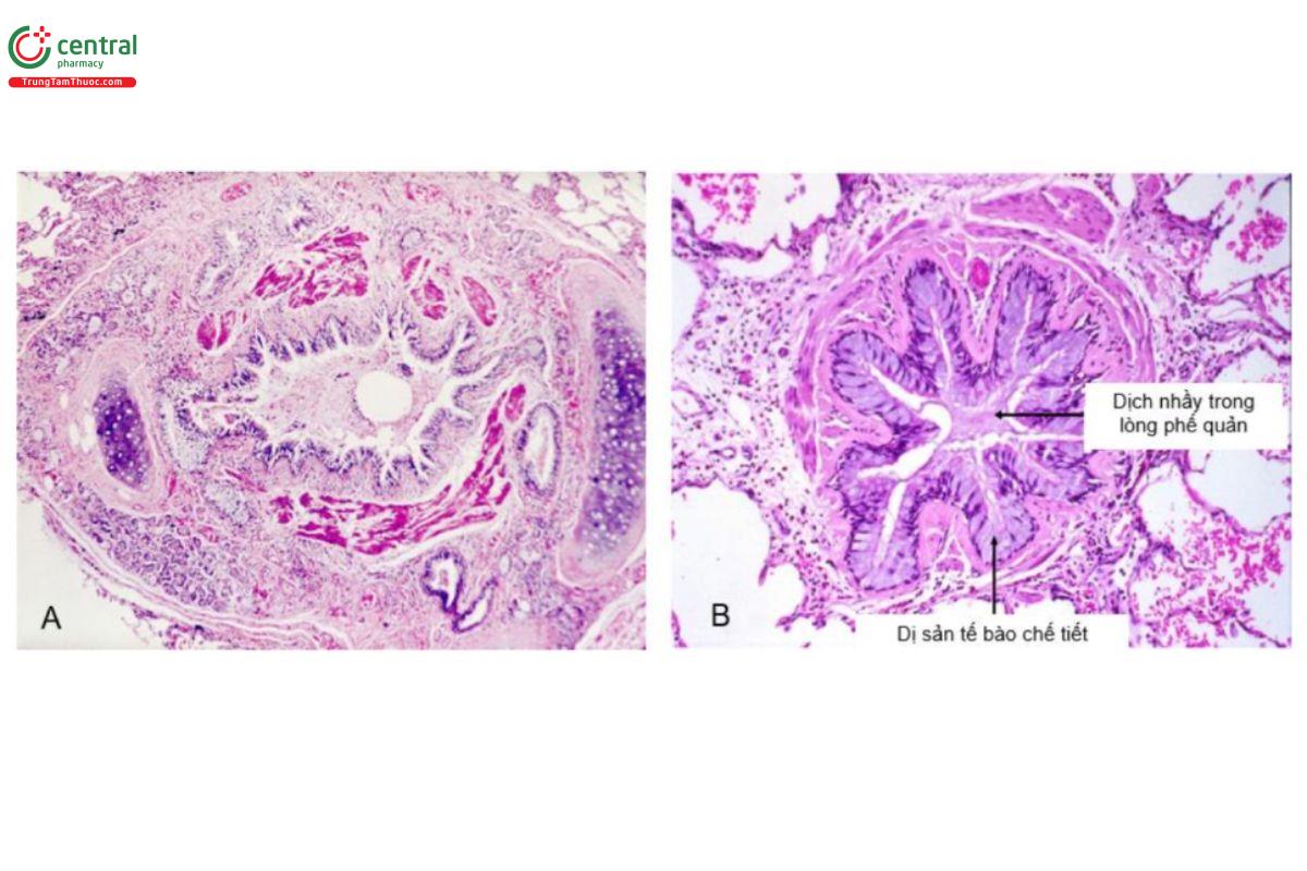 Hình 1.6. Nhìn dưới kính hiển vi A. Mô học đường thở lớn (có cấu trúc sụn) và B. đường thở nhỏ (không có cấu trúc  sụn) trong hen (Nguồn trích dẫn: từ Internet)