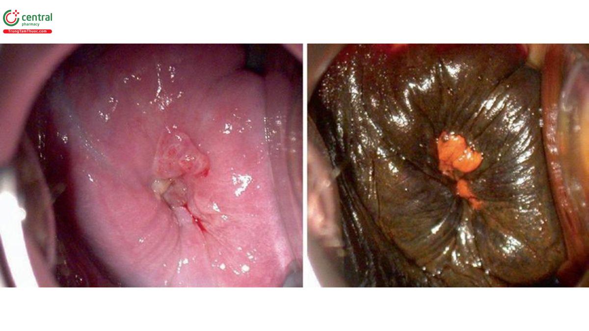 Hình 10.15 Polyp màng rụng ở tuần thứ 32 của thai kỳ. Một năm trước, bệnh nhân 31 tuổi đã được khoét chóp cổ tử cung vì HSIL. Có một khiếm khuyết mô đáng kể và sẹo. Polyp màng rụng âm tính với Lugol