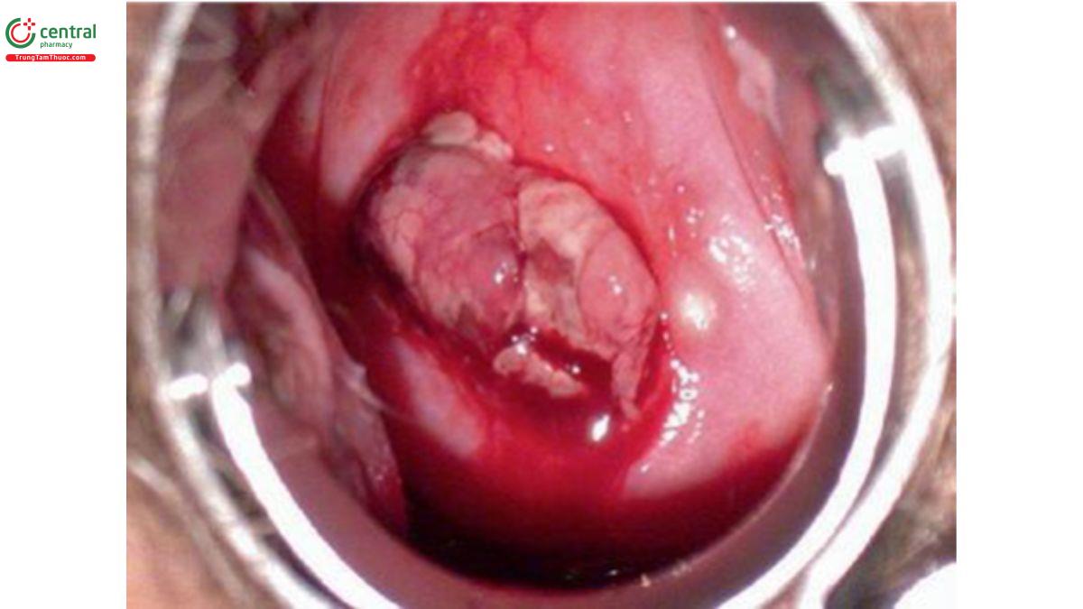 Hình 10.17 Polyp màng rụng ở tuần thứ 8 của thai kỳ. Chẩn đoán phân biệt bao gồm sẩy thai tự nhiên đang tiến triển và thậm chí là bệnh xâm lấn