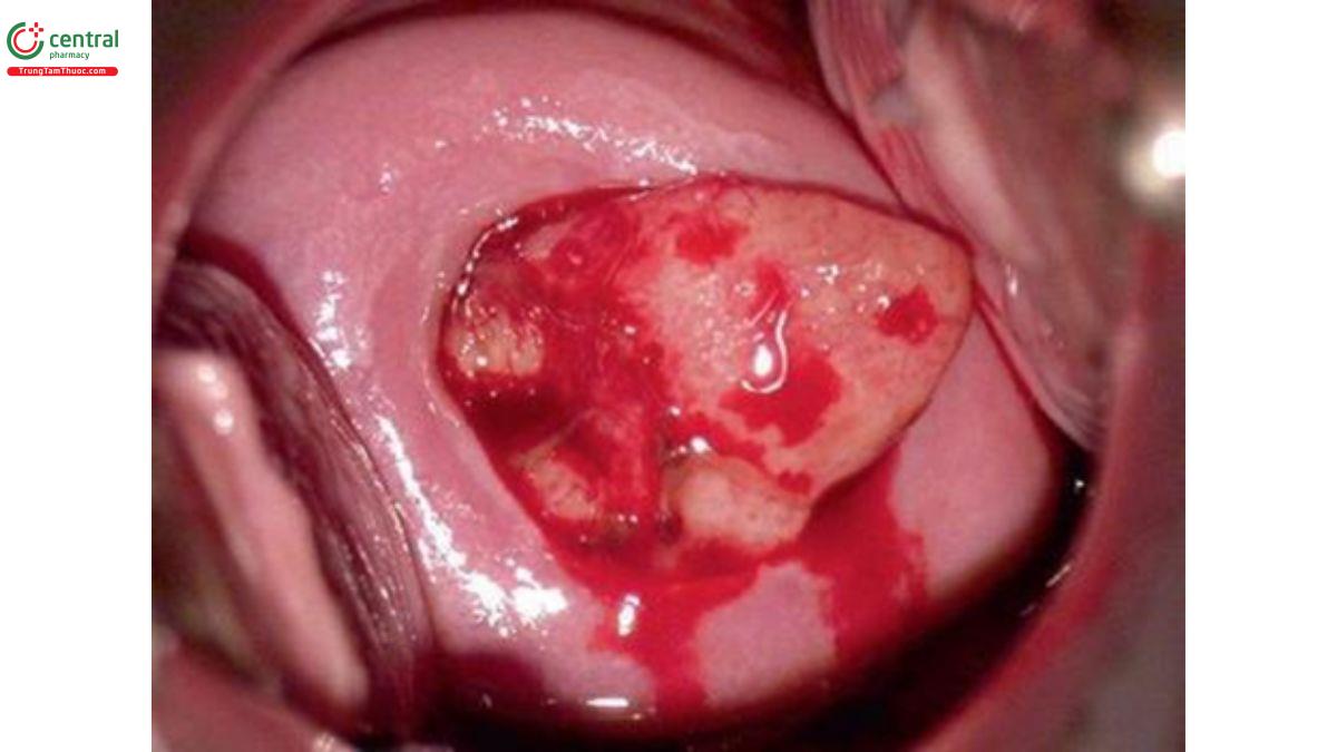 Hình 10.18 Polyp màng rụng ở tuần thứ 13 của thai kỳ. Nếu nghi ngờ, nên sinh thiết