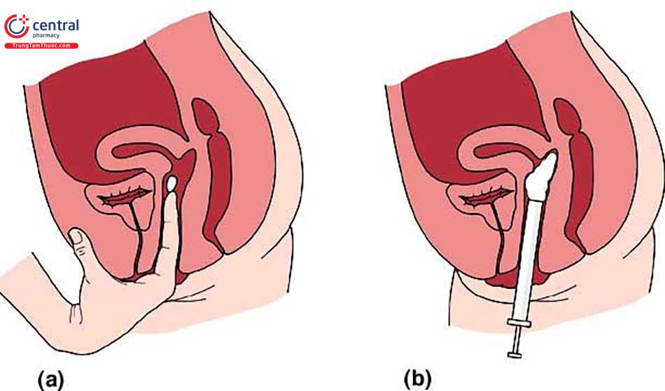 Sử dụng chất diệt tinh trùng để ngừa thai là yếu tố nguy cơ gây viêm âm đạo