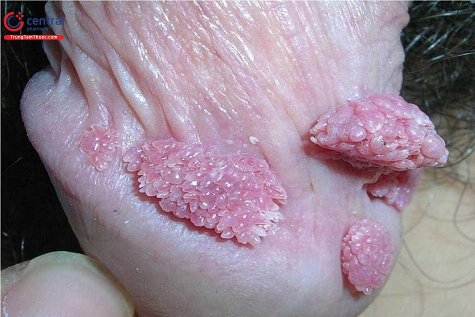 Sùi mào gà do HPV gây nên