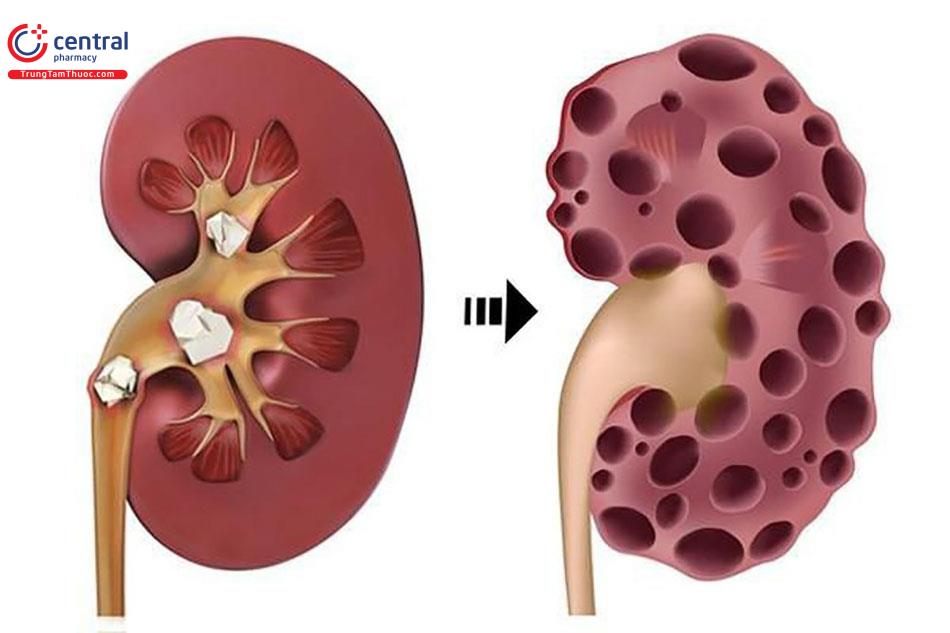 Suy thận do dùng thuốc điều trị lao