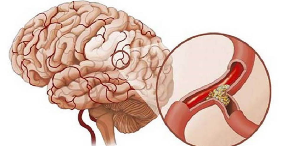 Bệnh tai biến mạch máu não (đột quỵ)