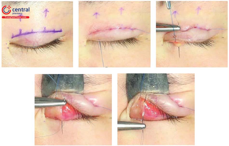 Tạo mắt hai mí không phẫu thuật: quy trình và lưu ý